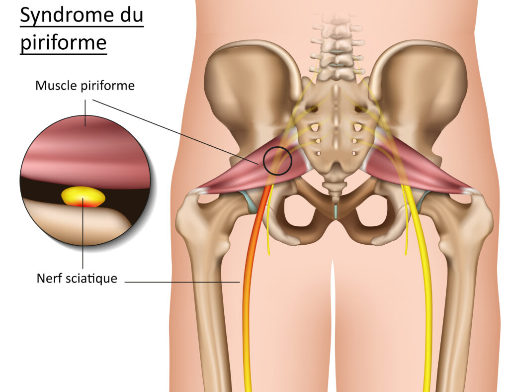 muscle piriforme